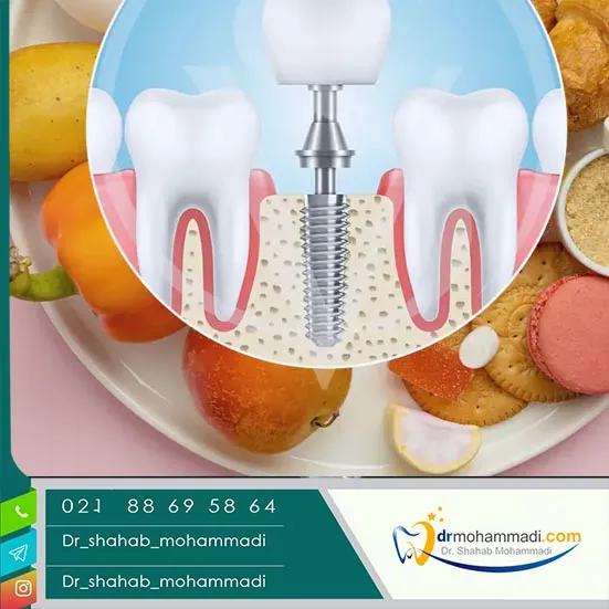 دستورالعمل‌های غذایی بعد از ایمپلنت (چه بخورید / نخورید)